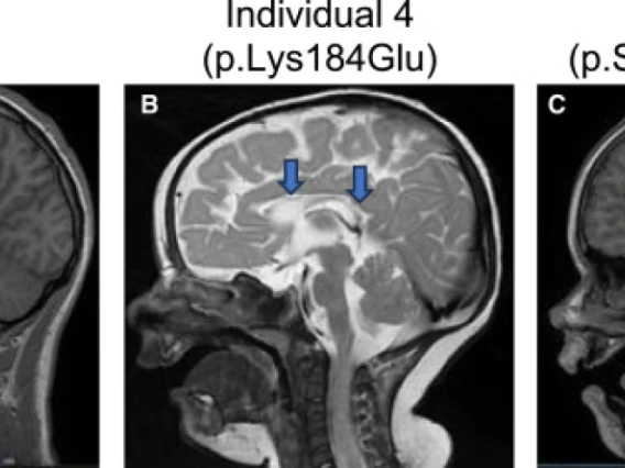 MRI Scans of 3 Individuals Displaying Variances in Regions of the Brain