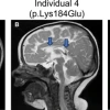 MRI Scans of 3 Individuals Displaying Variances in Regions of the Brain